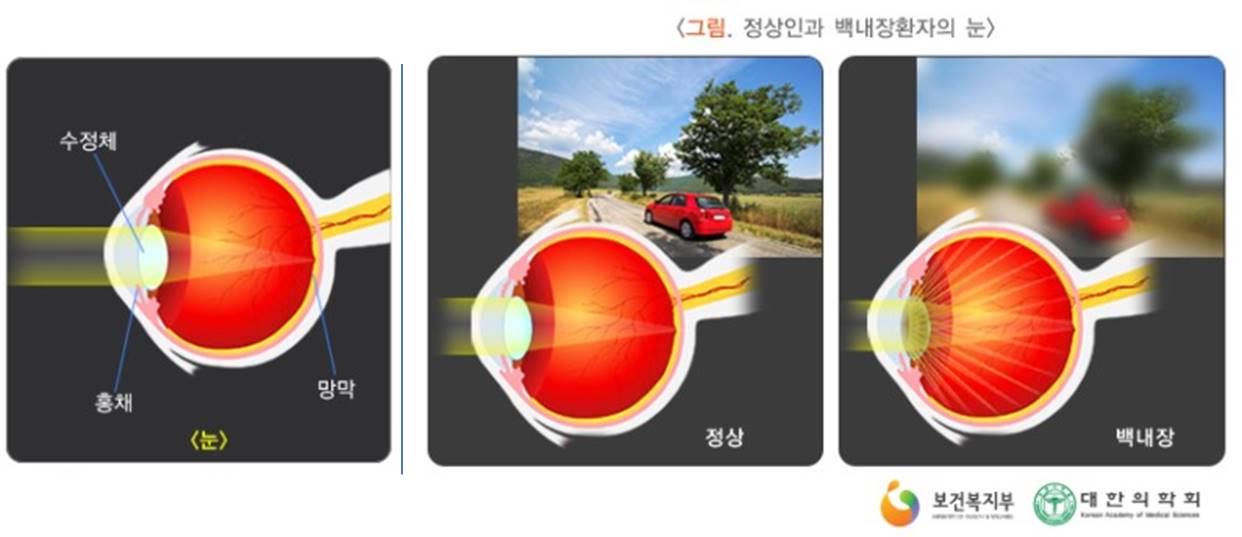  [질병] 백내장 증상과 치료방법
