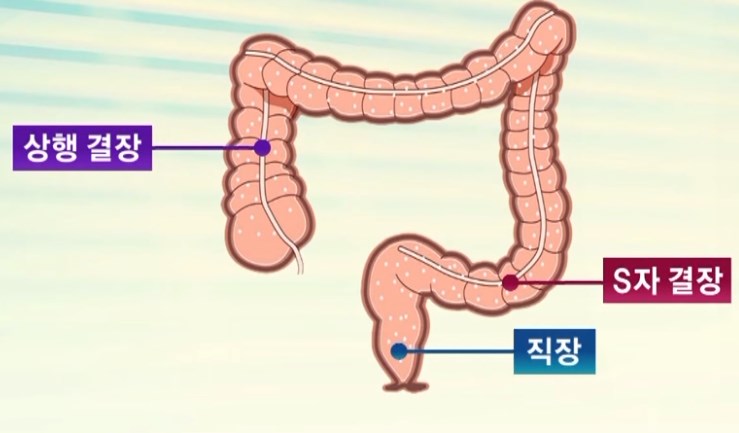  대장암 수술 이후 우리가 꼭 관리해줘야 될 것