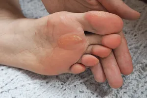발냄새-원인