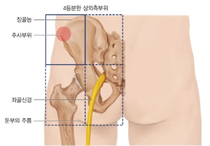  간호술기) 근육주사(IM) 부위, 부작용, 술기방법
