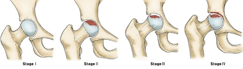 대퇴골두 무혈성 괴사 단계