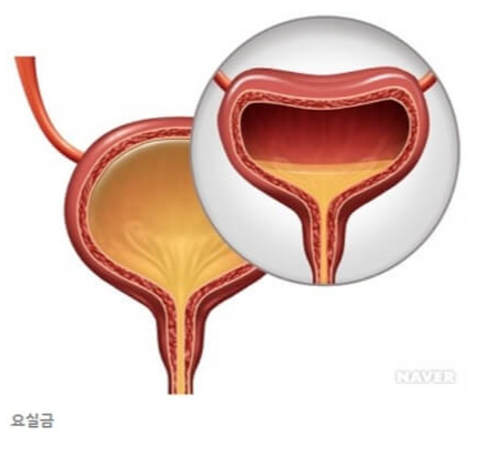 요실금이란