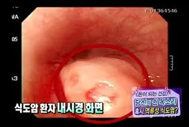 역류성 식도염 증상