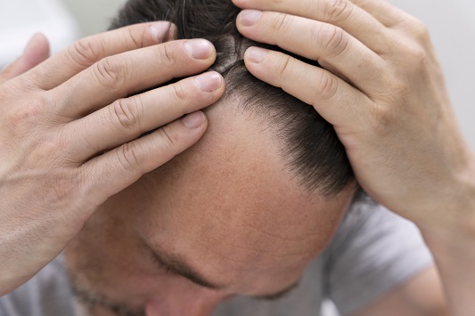 hair-loss-medicine