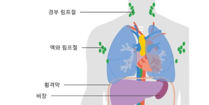 림프종