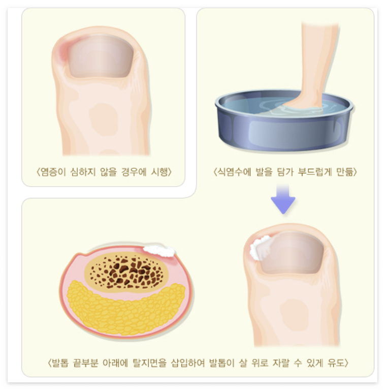 내성발톱 원인과 치료법 알아보기