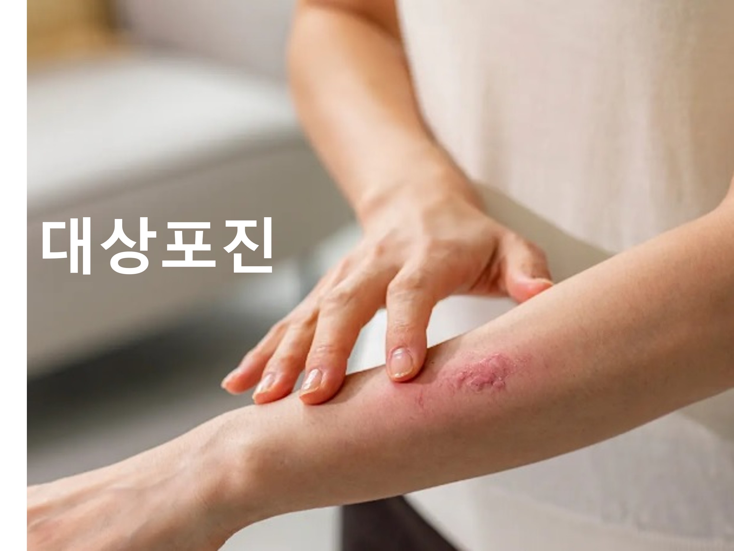  대상포진의 원인, 증상 및 치료 방법