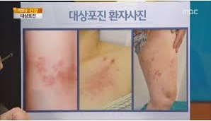  대상포진 초기증상 알아보기
