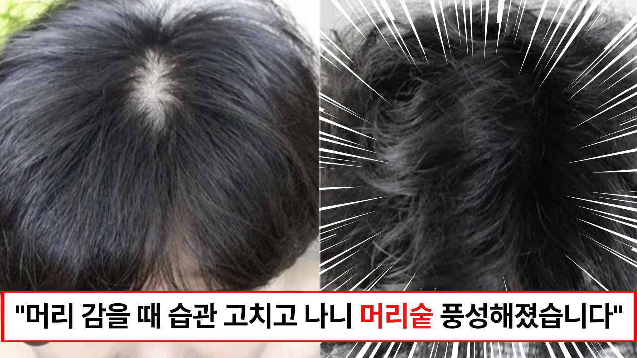 "매일같이 하던 습관 때문에 탈모가 올 수 밖에 없었습니다" 하지 말란 것만 안해도 머리숱이 바로 풍성해집니다.
