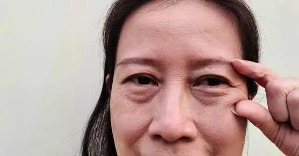 상안검 수술 비용 회복기간