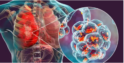  [건강정보]결핵 (Tuberculosis, TB): 원인과 치료