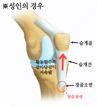 성인 오스굿씨병 사진