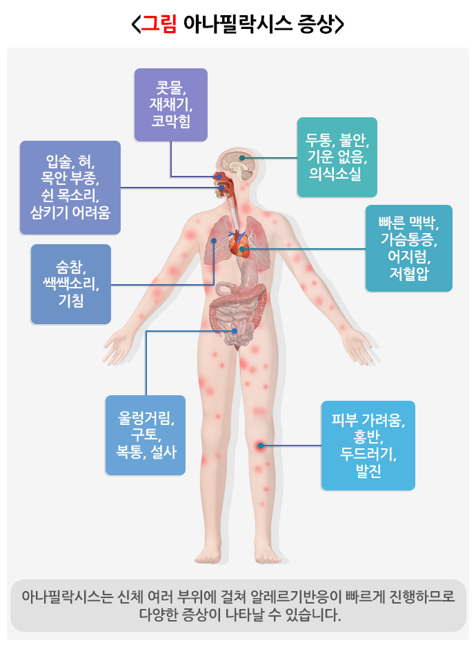 아나필락시스-증상