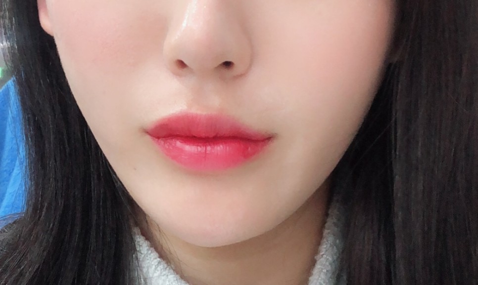  피부과 VVIP의 슈링크 후기 (통증, 부작용,전후까지)