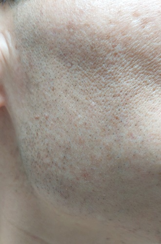 면도후 오른쪽 턱수염