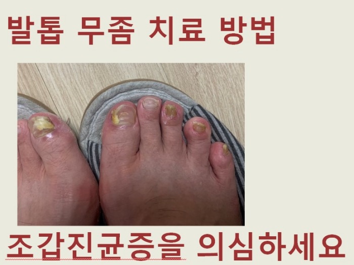  발톱무좀 원인 조갑 진균증 치료 방법, 약