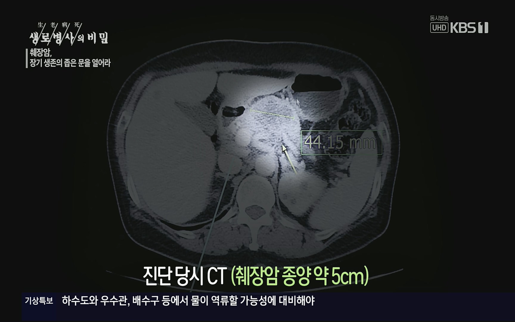 생로병사의 비밀.E823.220622p.H264-F1RST.mp4_20220624_210519.214.jpg