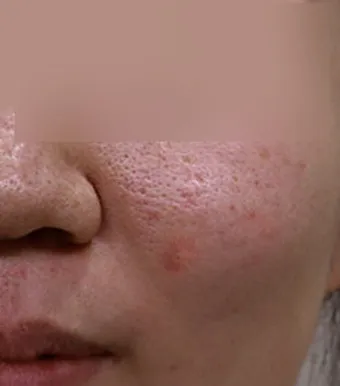흉터전용 치료 추천 스카덤 겔 효능효과_18