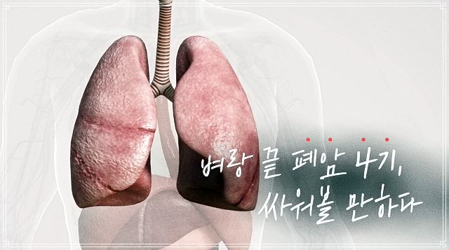 폐암 4기와 싸우는 방법: 감마 나이프와 뇌 전이 치료, 표적 항암제의 활용, 면역항암제를 통한 생존 기회 증가 – 874회 생로병사의 비밀