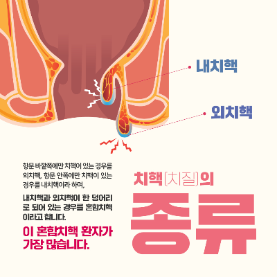 치질 증상