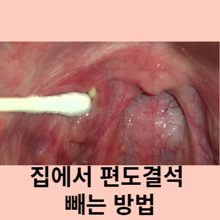 편도결석 빼는법