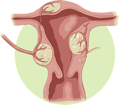 자궁-근종