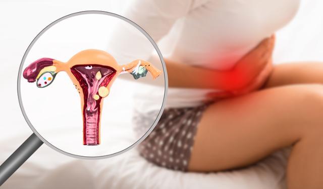 [여성암검사] 생리통인 줄 알았는데 자궁내막증&#44; 치료방법