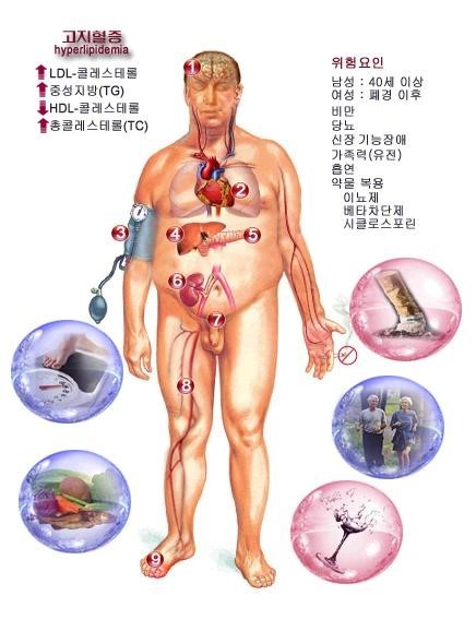 고지혈증0