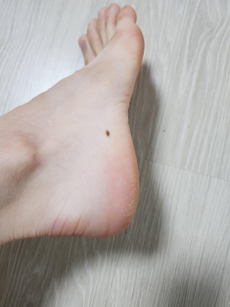 발각질 제거모습