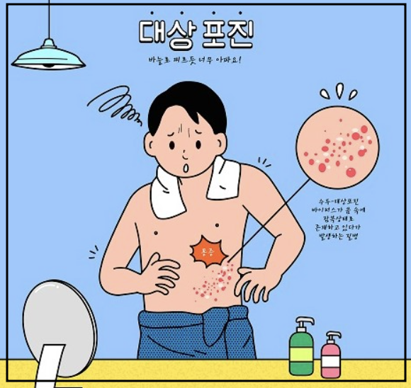 대상포진 사진3