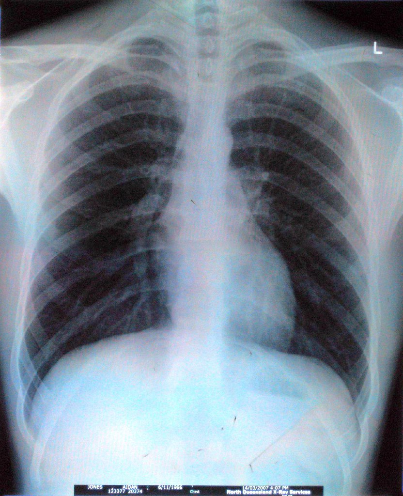  엑스레이(X-ray) 비용과 알짜 정보 공유