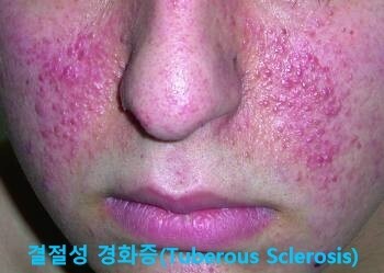  "결절성 경화증"(Tuberous Sclerosis")