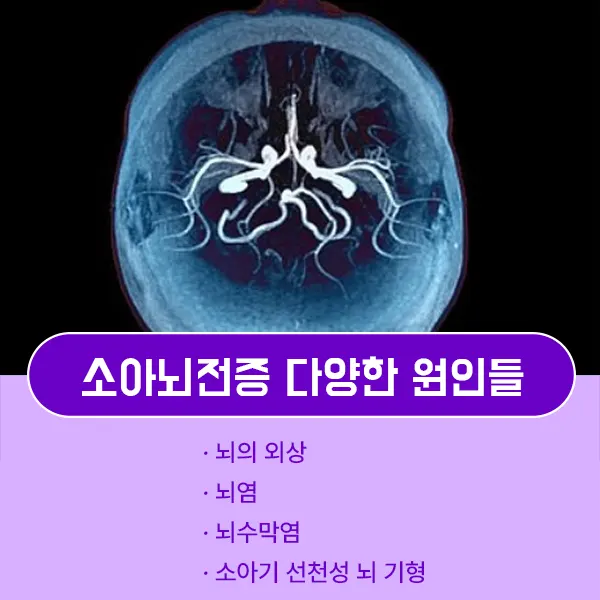 소아뇌전증 원인