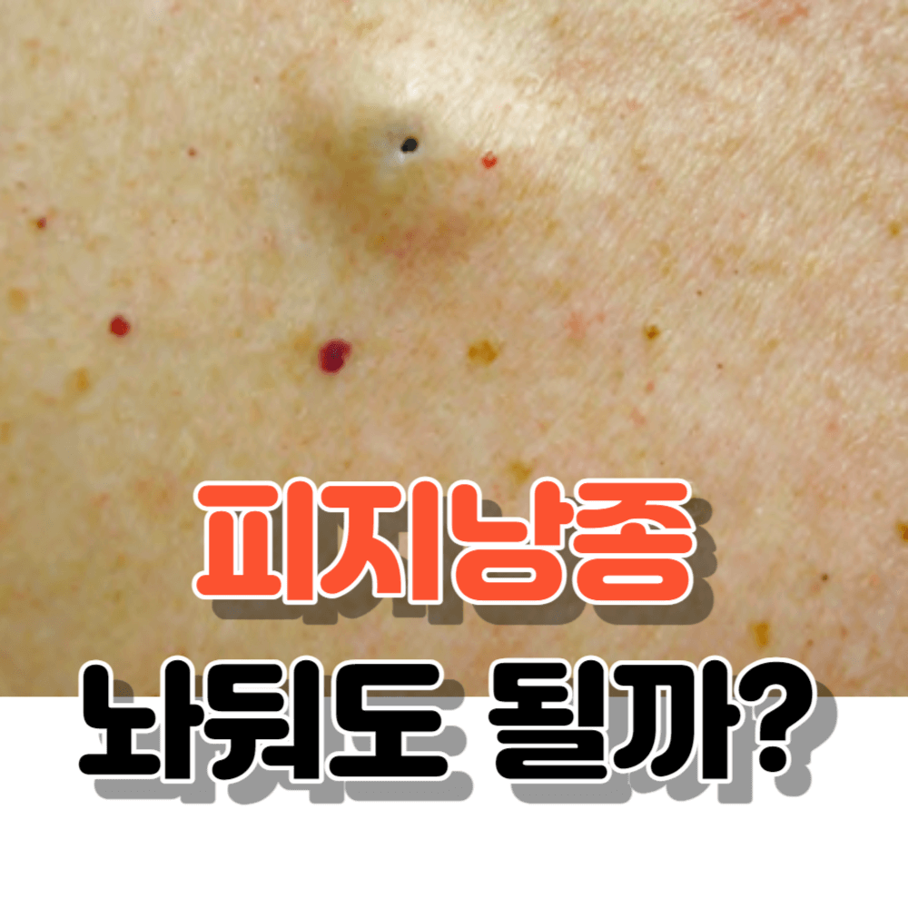 피지낭종