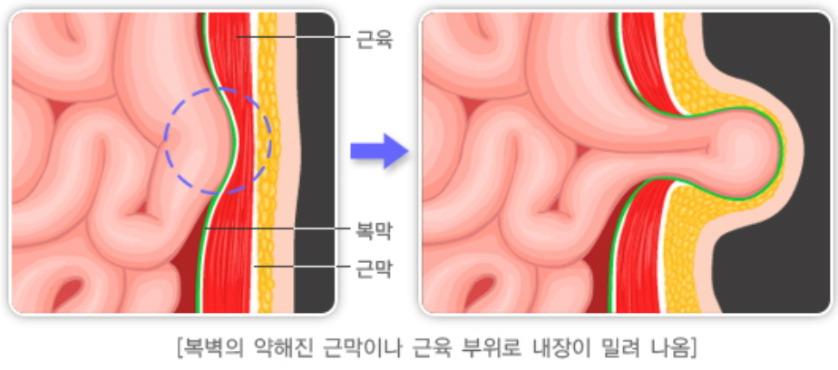 소아-탈장-발생-기전