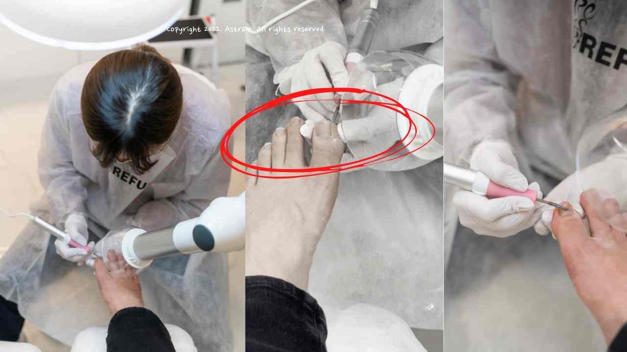 레푸스 가격 및 비용, 실제 후기 모음 (Feat. 레푸스 내성발톱 가격) 레푸스 가격 및 비용, 실제 후기 모음 (Feat. 레푸스 내성발톱 가격)