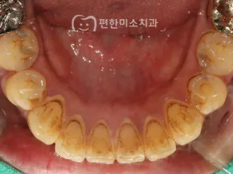 스케일링 후 양치 통증 음식_11