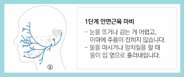 말초성 안면마비 신경손상 단계 이미지