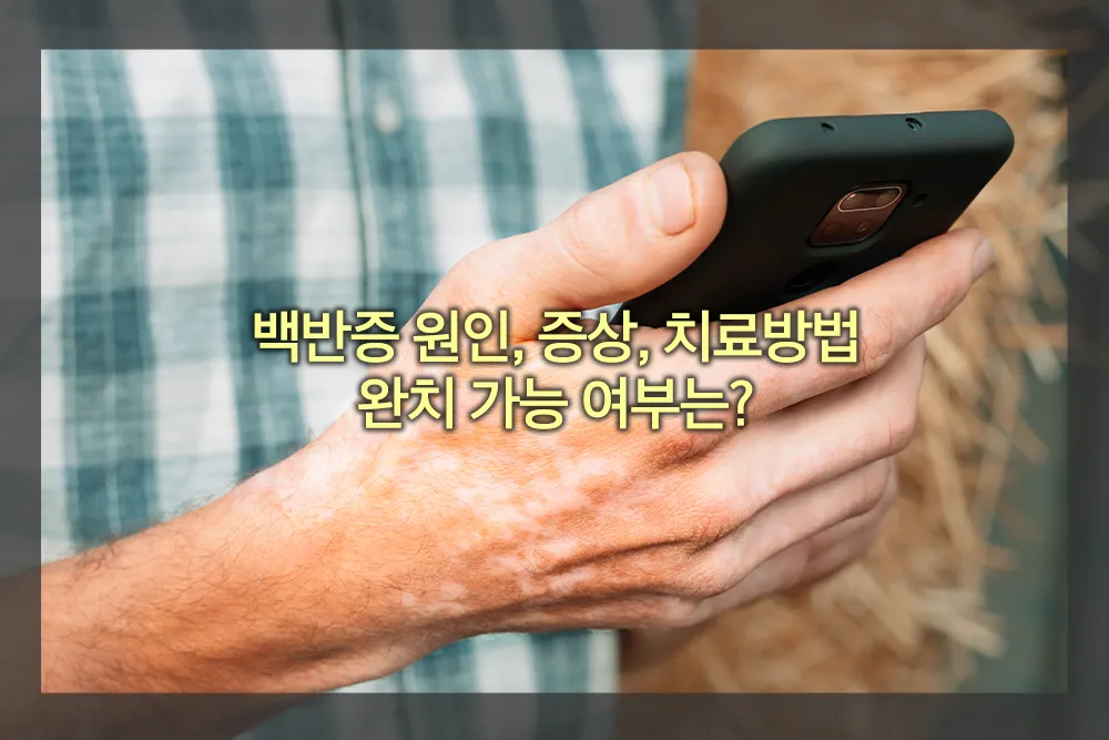 백반증 원인 증상 치료방법 완치 여부