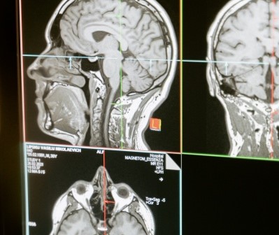 뇌-스캔