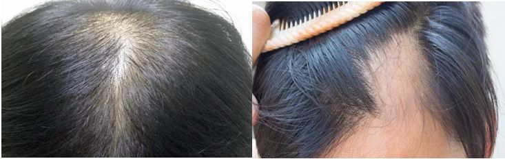  가장 이상적인 탈모 건강기능식품은 뭐가 있을까요?