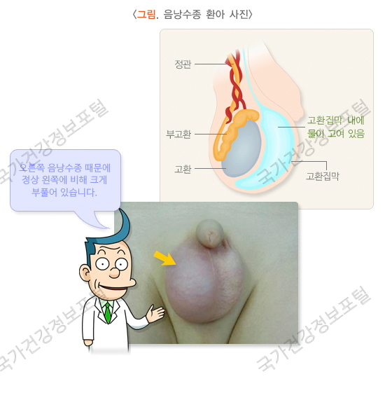 음낭수종 사진