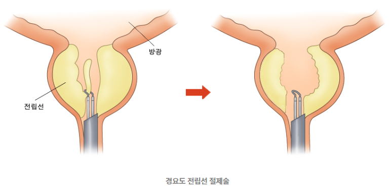 전립선 비대증 수술 비용
