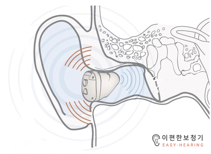  보청기 착용시 발생하는 피드백(Feedback)잡음 제거방법 - 대화동보청기