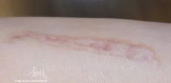 흉터전용 치료 추천 스카덤 겔 효능효과_6
