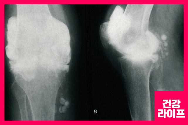 관절 염증 엑스레이