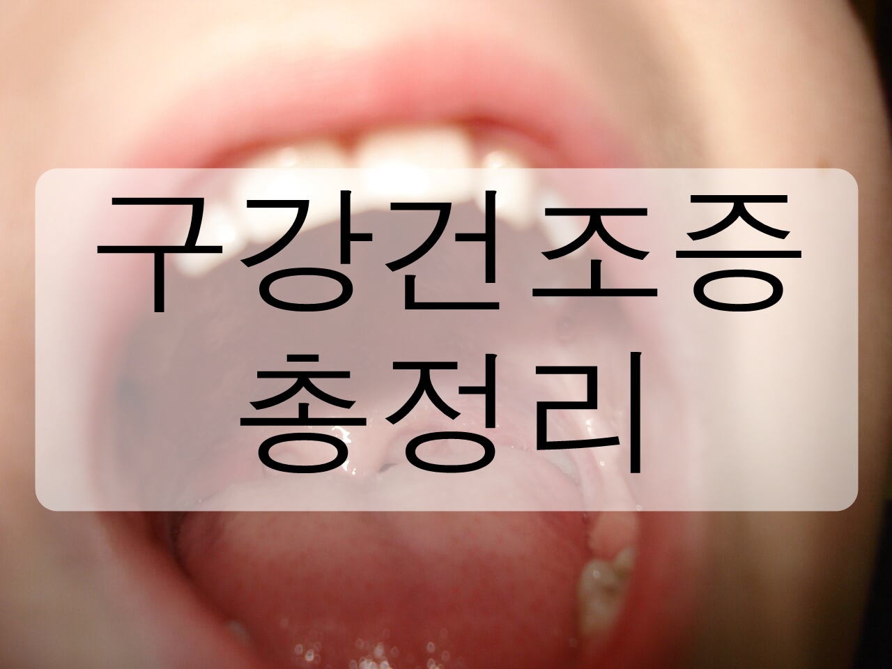  구강건조증에 대해 알아보자! (원인, 자가진단, 치료방법)