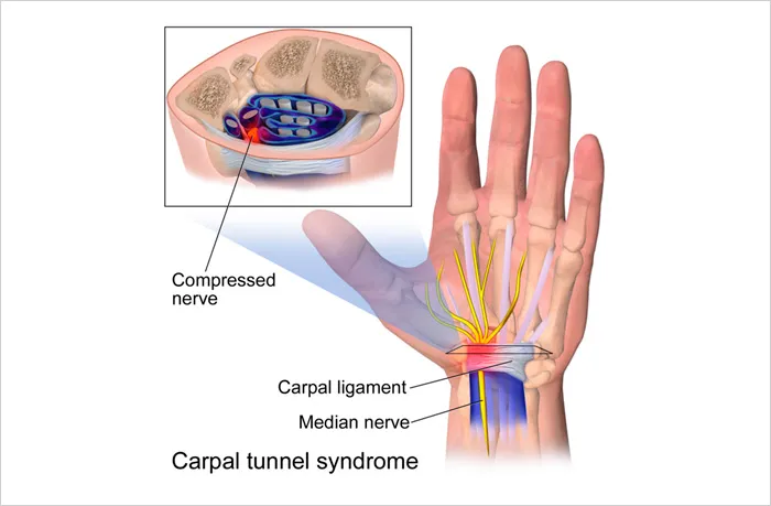 손목터널증후군 증상