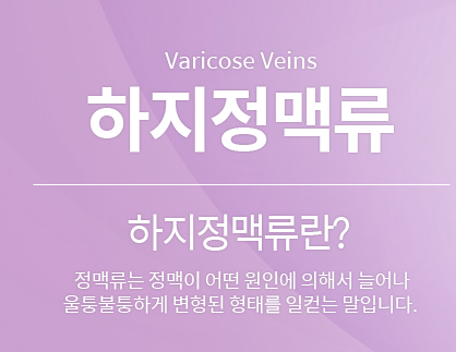  하지정맥류의 원인과 증상, 치료방법