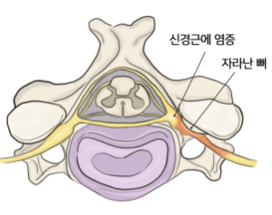 신경통 증상
